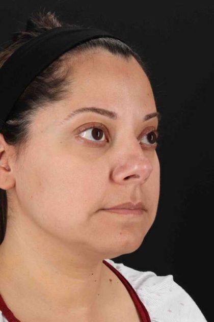 Buccal Fat Pad Before & After Patient #1436