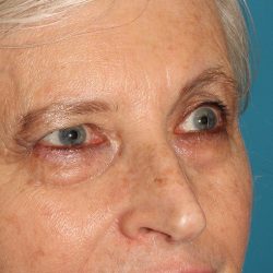 Lower Blepharoplasty Before & After Patient #2419