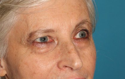 Upper Blepharoplasty Before & After Patient #3532