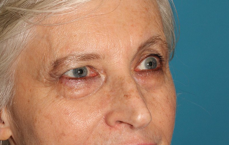 Upper Blepharoplasty Before & After Patient #3532