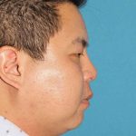 Buccal Fat Pad Before & After Patient #1474