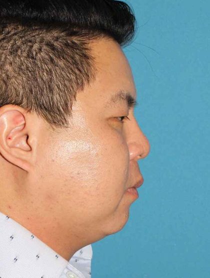Buccal Fat Pad Before & After Patient #1474