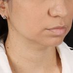 Chin Implant Before & After Patient #1540