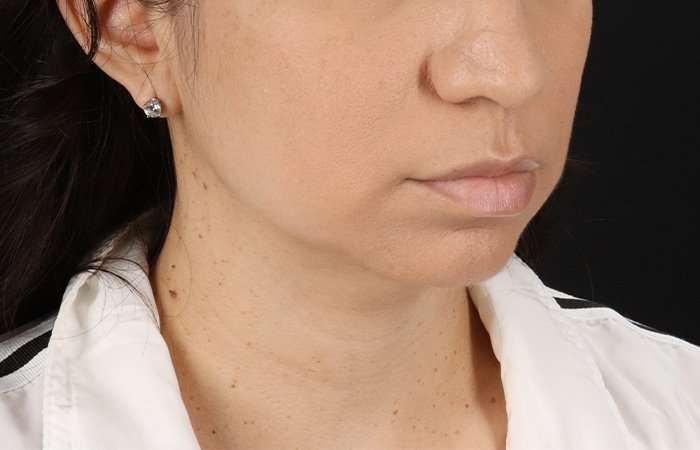 Chin Implant Before & After Patient #1540