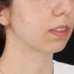 Chin Implant Before & After Patient #1551