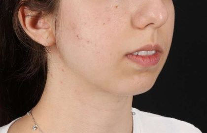 Chin Implant Before & After Patient #1551