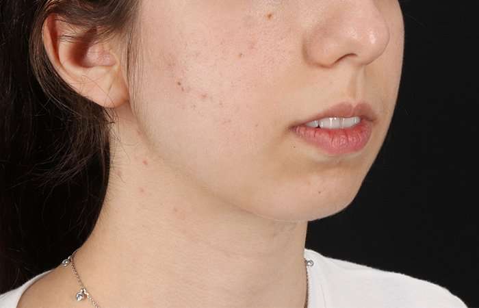 Chin Implant Before & After Patient #1551