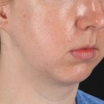 Chin Implant Before & After Patient #1562