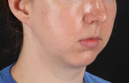 Chin Implant Before & After Patient #1562