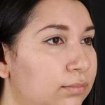 Chin Implant Before & After Patient #1604