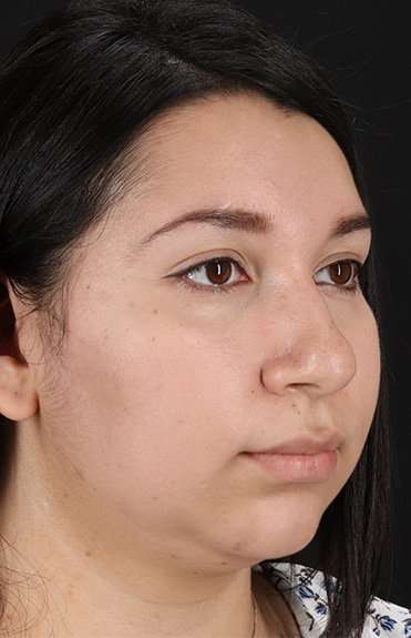 Chin Implant Before & After Patient #1604