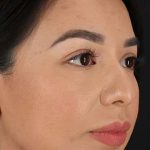 Chin Implant Before & After Patient #1626