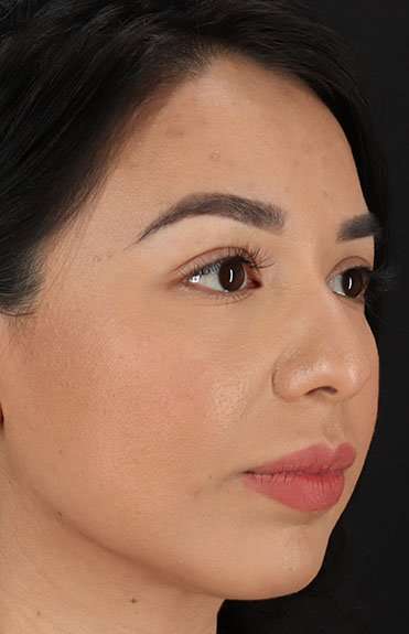 Chin Implant Before & After Patient #1626