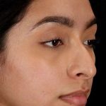 Chin Implant Before & After Patient #1637