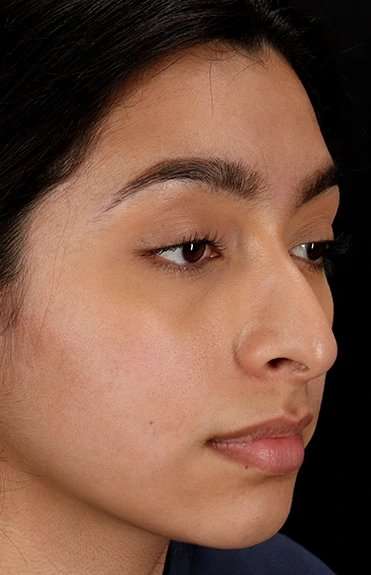 Chin Implant Before & After Patient #1637