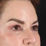 Browlift Before & After Patient #1253