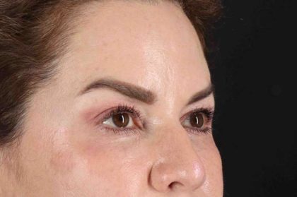 Browlift Before & After Patient #1253