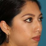 Chin Implant Before & After Patient #1670