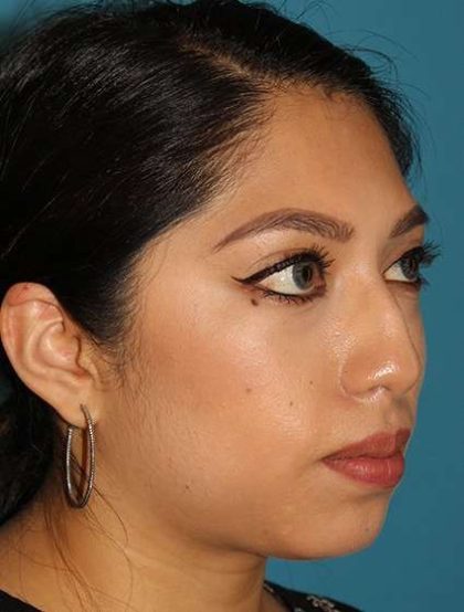Chin Implant Before & After Patient #1670