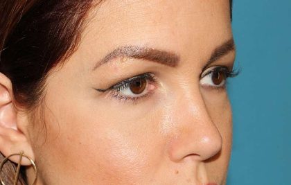 Eyelid Lift Before & After Patient #1729