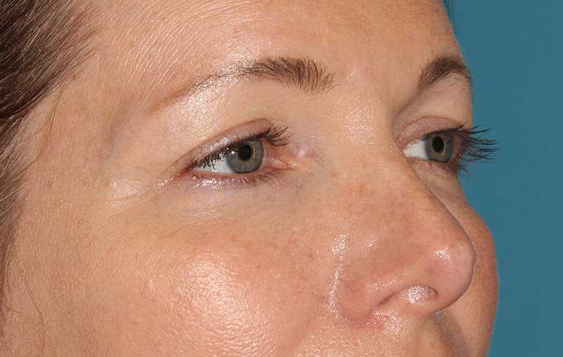 Eyelid Lift Before & After Patient #1736