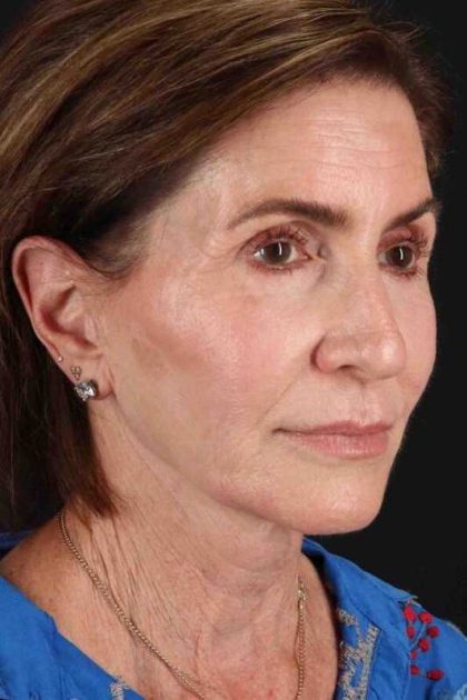 Facelift Before & After Patient #1789