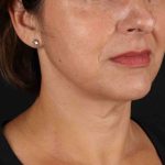 Facelift Before & After Patient #1809