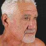Facelift Before & After Patient #1820