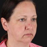 Facelift Before & After Patient #1843