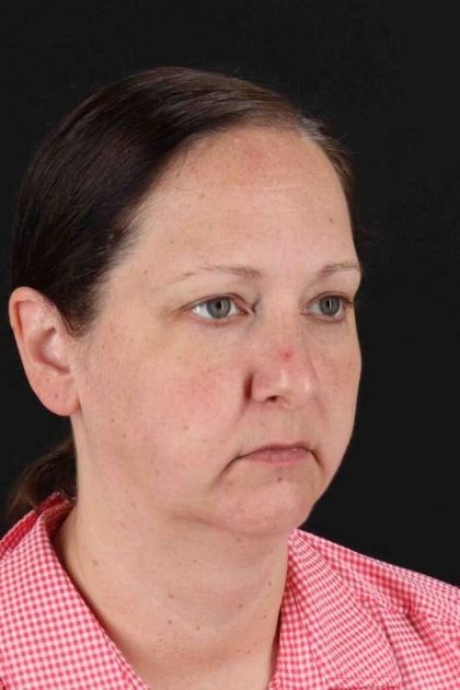 Facelift Before & After Patient #1843