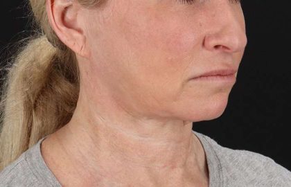 Facelift Before & After Patient #1866