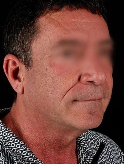 Facelift Before & After Patient #1899