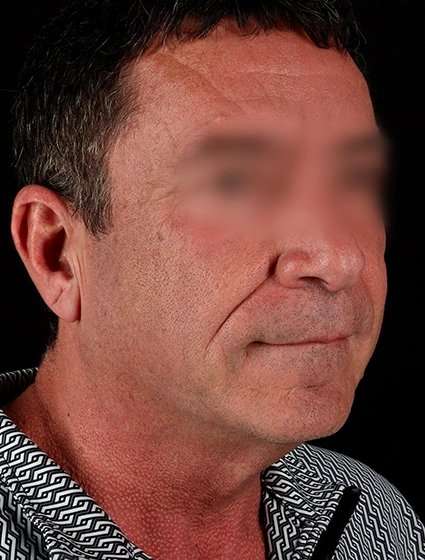 Facelift Before & After Patient #1899