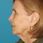 Facelift Before & After Patient #1959