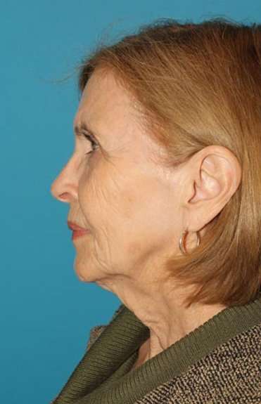 Facelift Before & After Patient #1959