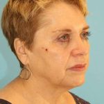 Facelift Before & After Patient #1975