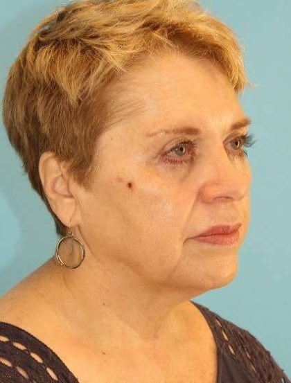 Facelift Before & After Patient #1975