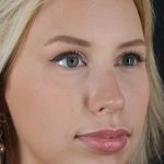 Fillers Before & After Patient #2030