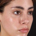 Fillers Before & After Patient #2052