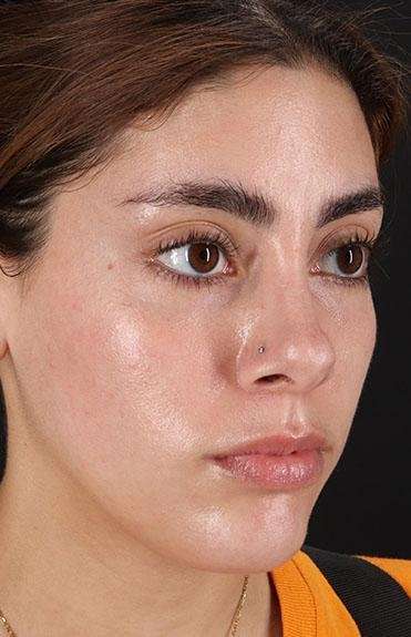Fillers Before & After Patient #2052