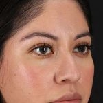 Fillers Before & After Patient #2063