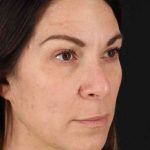 Lip Lift Before & After Patient #2133