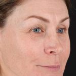 Lip Lift Before & After Patient #2144