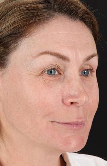 Lip Lift Before & After Patient #2144