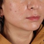 Lip Lift Before & After Patient #2166
