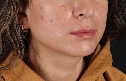 Lip Lift Before & After Patient #2166