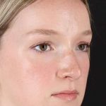 Liquid Rhinoplasty Before & After Patient #2177
