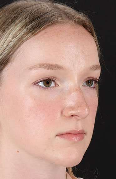 Liquid Rhinoplasty Before & After Patient #2177