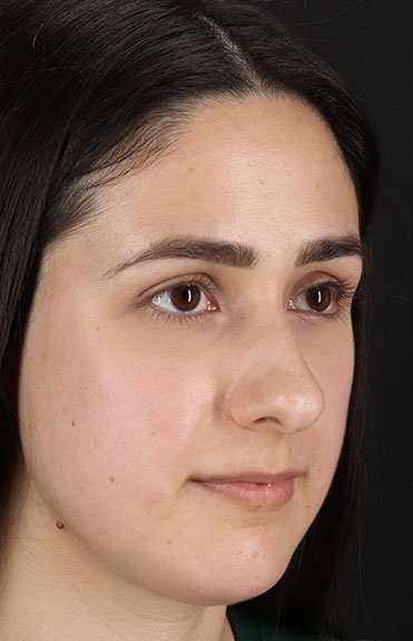 Liquid Rhinoplasty Before & After Patient #2188