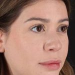 Liquid Rhinoplasty Before & After Patient #2210